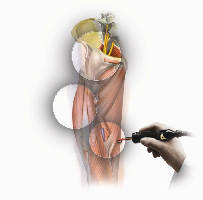 HILTERAPIA®